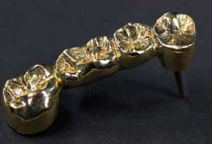 gold teeth (bridge)